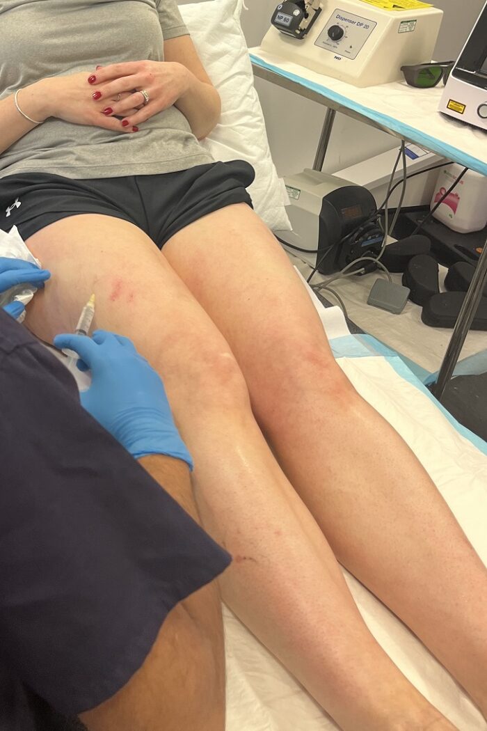 Sclerotherapy Treatment Part Two At Veincentre Manchester